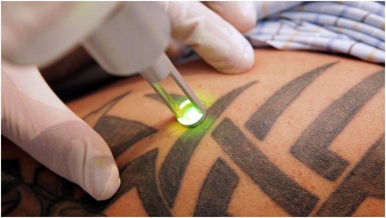 Tattoo-Entfernung: Mittel und Methoden. Tattoo-Entfernung mit Laser: Bewertungen 02