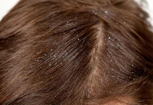 Wie man Dandruff loswerden? Kämpfe trockener und fettiger Dandruffe 01