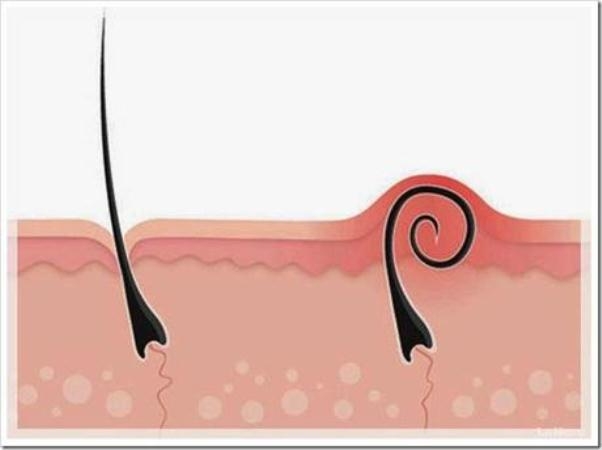 Eingewachsenes Haar an den Beinen: Warum erscheinen und wie man mit ihnen umgehen soll? 01