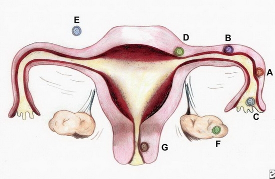 Gelber Körper im Eierstock während der Schwangerschaft - Norm oder Pathologie? Welche Konsequenzen können die gelbe Körperzyste führen?? 02