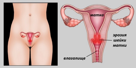 Was ist eine gefährliche Erosion des Gebärmutterhalses: Arten von Pathologie, Symptome, Behandlung 01