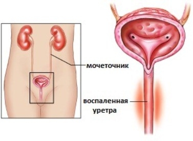 Ureteritis bei Frauen: Symptome und Behandlung 02