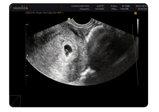 Embryo-Größe für Wochen: Tabellen mit Beschreibung. So ermitteln Sie die Größe des Fötus für Schwangerschaftswochen mit Ultraschall? 02