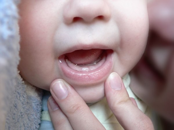 Wie viele Milchzähne sollten bei Kindern sein?? Ist es notwendig für die Behandlung von Milchzahn? 01