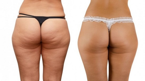 Übungen, um Cellulite auf Hüften und Gesäß loszuwerden 01