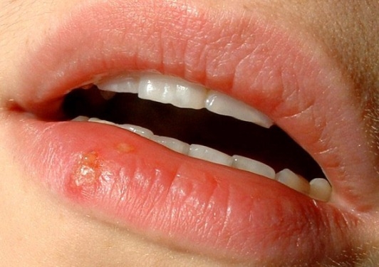 Herpes an den Lippen: Ursachen 01