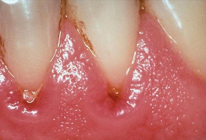 Gingivitis: Symptome und Behandlung. Wie man Gingivitis bei Kindern behandelt? 04