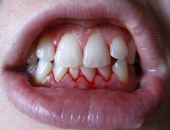 Gingivitis: Symptome und Behandlung. Wie man Gingivitis bei Kindern behandelt? 05