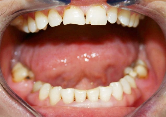 Gingivitis: Symptome und Behandlung. Wie man Gingivitis bei Kindern behandelt? 06