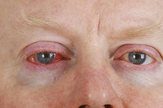 Wie man Konjunktivitis bei Erwachsenen zu Hause behandelt? 01