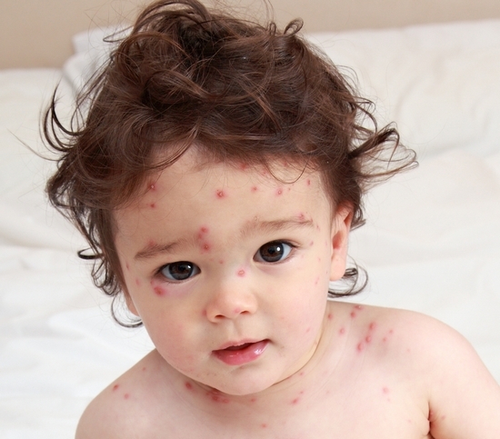 Wie man Windpox bei Kindern zu Hause behandelt: Top-Tipps 02