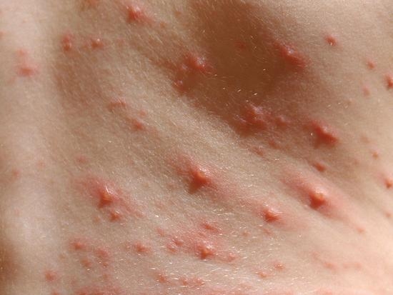 Wie man Windpox bei Kindern zu Hause behandelt: Top-Tipps 03