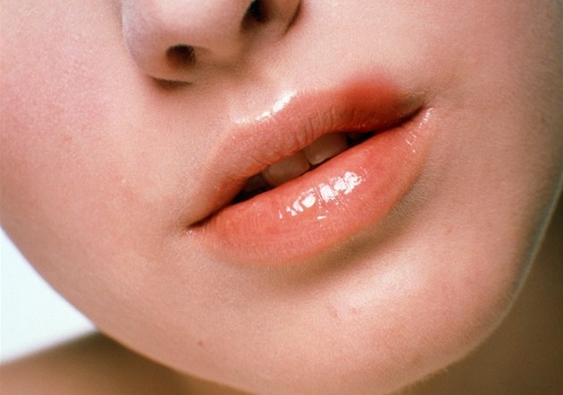 Wie ist Herpes auf Lippen, Genitalgeschäft?? Ob Herpes mit einem Kuss übertragen wird? 02