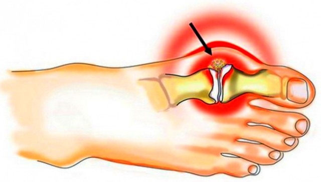 Knochen an den Beinen: Wie zu behandeln? Knochen an den Beinen: Wie zu bilden? 02