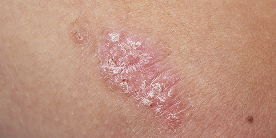 Behandlung von Psoriasis zu Hause: Grundlegende Methoden und Bewertungen über sie 01