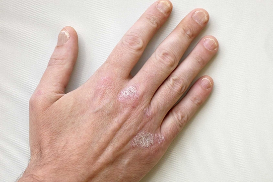 Behandlung von Psoriasis zu Hause: Grundlegende Methoden und Bewertungen über sie 08