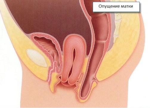 Überführung der Gebärmutter: Symptome und Behandlung 01