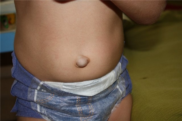 Baby Hernia. Symptome der Krankheit und der Merkmale seiner Entwicklung in Babys 01