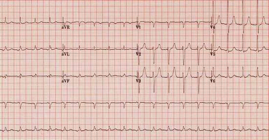 Puls: Norm nach Alter bei Erwachsenen und Kindern. Frequenz des Normalimpulses nach Alter 04