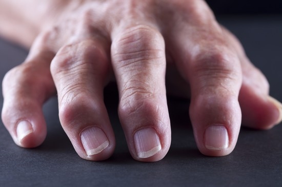Rheumatoide Arthritis von Fingern: Erste Symptome und Behandlung 01