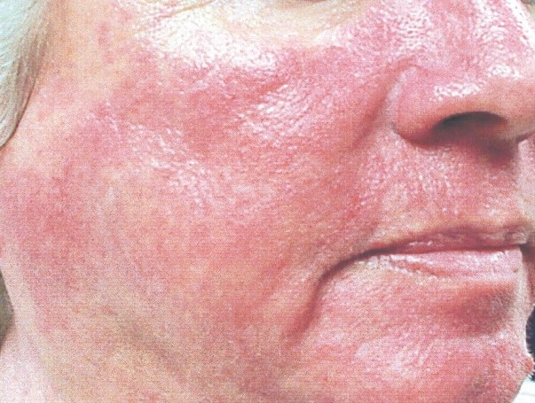 Rosacea: Behandlung. Die Hauptursachen und Symptome der Entwicklung des Watches 01