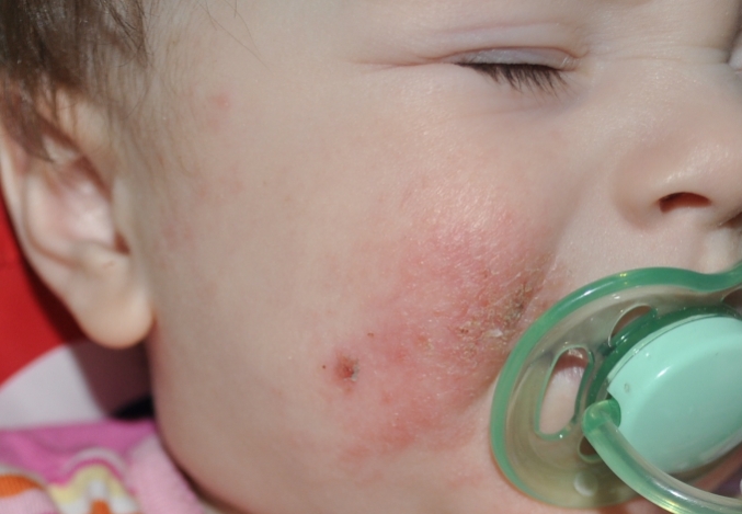 Streptodermie bei Kindern: Behandlung. Wie man Streptodermia-Volksmittel behandelt? 01