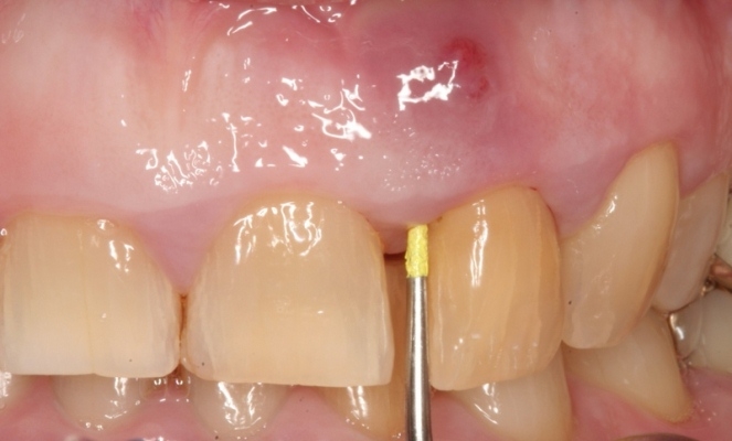 Spisch auf dem gum: was ist es? Ursachen der Entwicklung der Fistel und ihrer klinischen Manifestationen 03