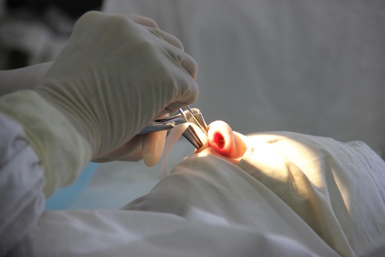 Polypen-Entfernung. Behandlung mit einem Laser, löschen mit der Operation mit der Verwendung von Shawra 01