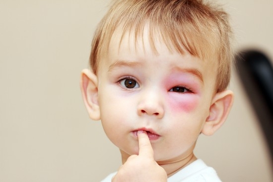 Virale Konjunktivitis bei Kindern: Symptome und Behandlung 01