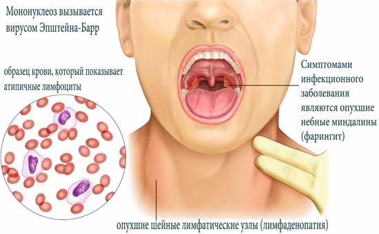 Epstein Barra-Virus bei Kindern: Symptome, Behandlung. Was macht das Capsid-Antigen des Epstein Barra?? 03