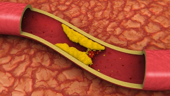 Statine: Für und gegen, Schaden und Nutzen, Bewertungen, Liste der Medikamente, um das Cholesterin der letzten Generation zu reduzieren 02