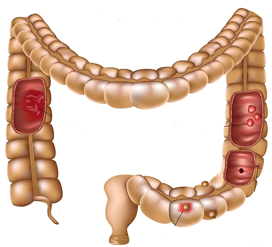 Farben von Schmerzen im Bauch: eine Liste von Schmerzmittel während der Gastritis, Geschwüre und anderen Problemen 07