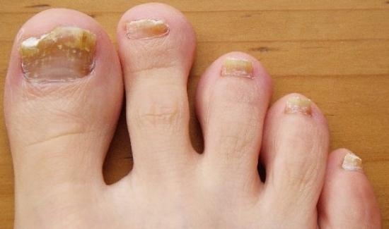 Behandlung von Nagelpilz von Essig: Nutzerbewertungen und Spezialisten 01