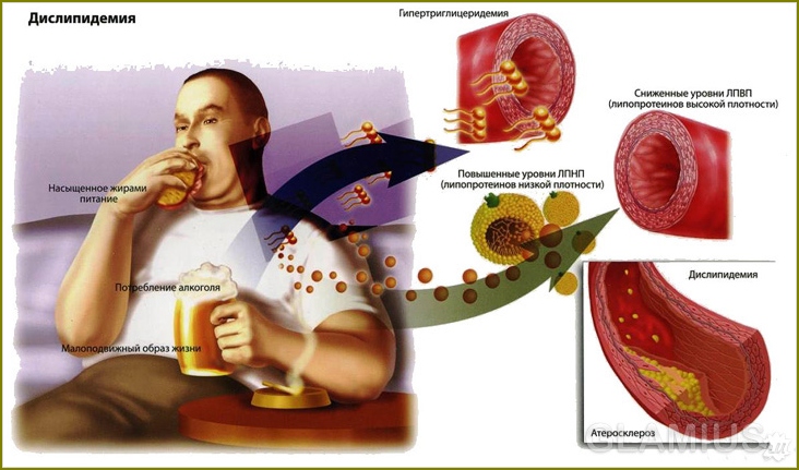 Reduzieren des Cholesterins im Blut 03