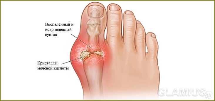 Wie man Arthritis-Füße zu Hause behandelt 03