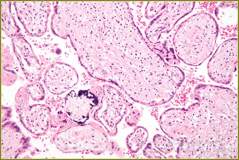 Cytomegalovirus während der Schwangerschaft 02